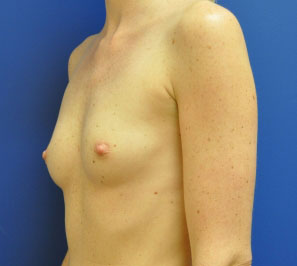 Silicone Breast Augmentation