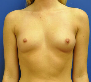 Silicone Breast Augmentation