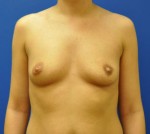 Silicone Breast Augmentation