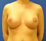 Silicone Breast Augmentation