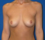 Silicone Breast Augmentation