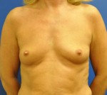 Silicone Breast Augmentation