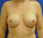 Silicone Breast Augmentation
