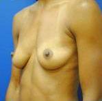 Silicone Breast Augmentation