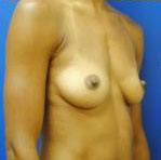 Silicone Breast Augmentation