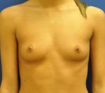 Silicone Breast Augmentation
