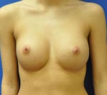 Silicone Breast Augmentation