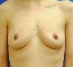 Saline Breast Augmentation
