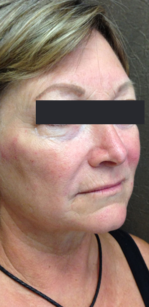 Dermal Filler