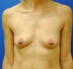 Saline Breast Augmentation