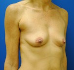 Saline Breast Augmentation