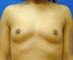 Saline Breast Augmentation