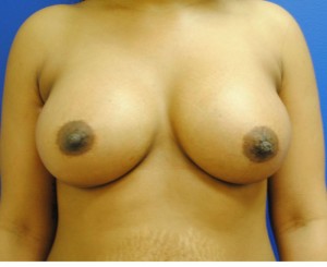 Saline Breast Augmentation