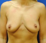 Saline Breast Augmentation