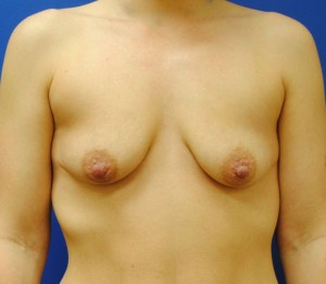 Breast Enhancement (Breast Lift with Implants)