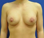 Breast Enhancement (Breast Lift with Implants)