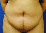 Tummy Tuck