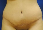 Tummy Tuck