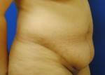 Tummy Tuck