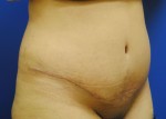 Tummy Tuck