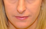 Dermal Filler
