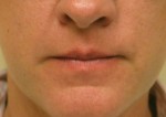 Dermal Filler
