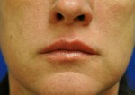 Dermal Filler