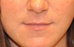 Dermal Filler
