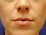 Dermal Filler