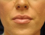 Dermal Filler