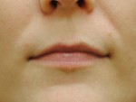 Dermal Filler