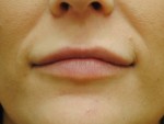 Dermal Filler