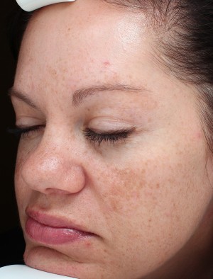 Sciton Laser Treatments