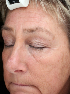 Sciton Laser Treatments