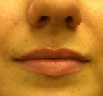 Dermal Filler