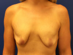 Breast Enhancement (Breast Lift with Implants)