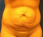 Tummy Tuck