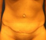 Tummy Tuck