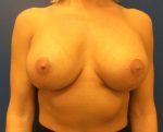 Breast Enhancement (Breast Lift with Implants)