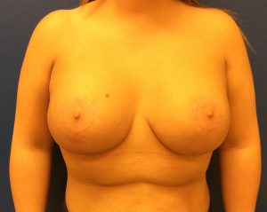 Breast Enhancement (Breast Lift with Implants)