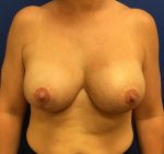 Breast Revision