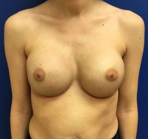 Breast Revision Case 6632 After Photo Breast Revision