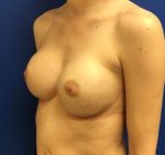 Breast Revision