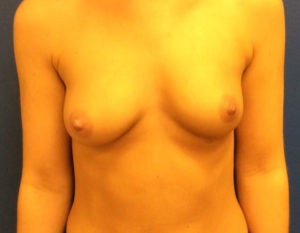 Silicone Breast Augmentation Case 7040 Before Photo Silicone Breast Augmentation