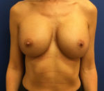 Breast Revision