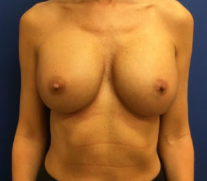 Breast Revision