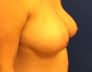 Breast Lift Case 7061 Before Photo Breast Lift