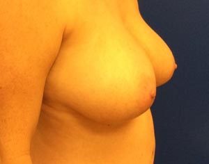 Breast Lift