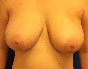 Breast Lift Case 7061 Before Photo Breast Lift