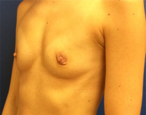 Silicone Breast Augmentation Case 7101 Before Photo Silicone Breast Augmentation